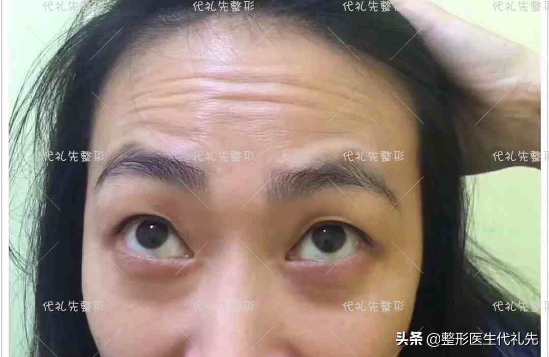 抬头纹怎么消？|有了抬头纹要怎么办？