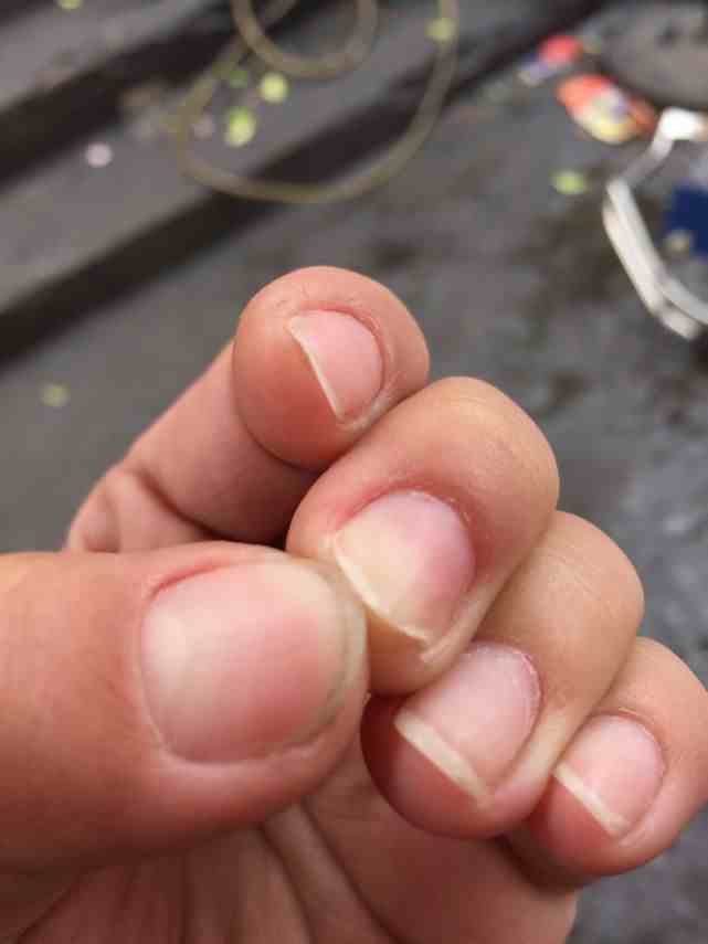 关于灰指甲你知道多少呢？