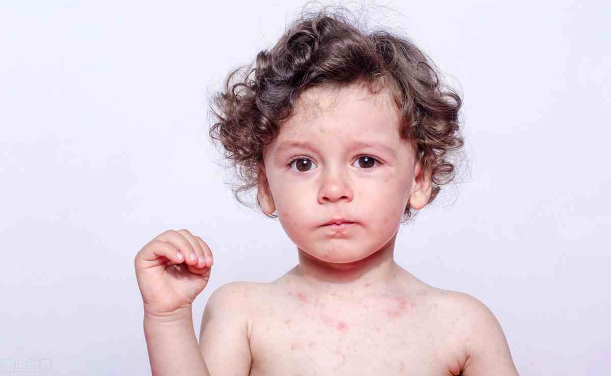 过敏性荨麻疹的治疗|荨麻疹的简单又根治的方法