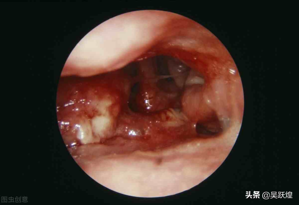 鼻咽癌颈部包块位置图片