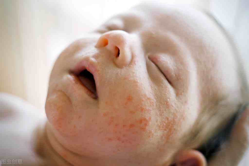 婴儿湿疹治疗（宝宝得了湿疹了怎么治疗？）