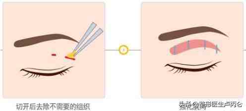 韩式经典双眼皮（韩式双眼皮效果如何？）