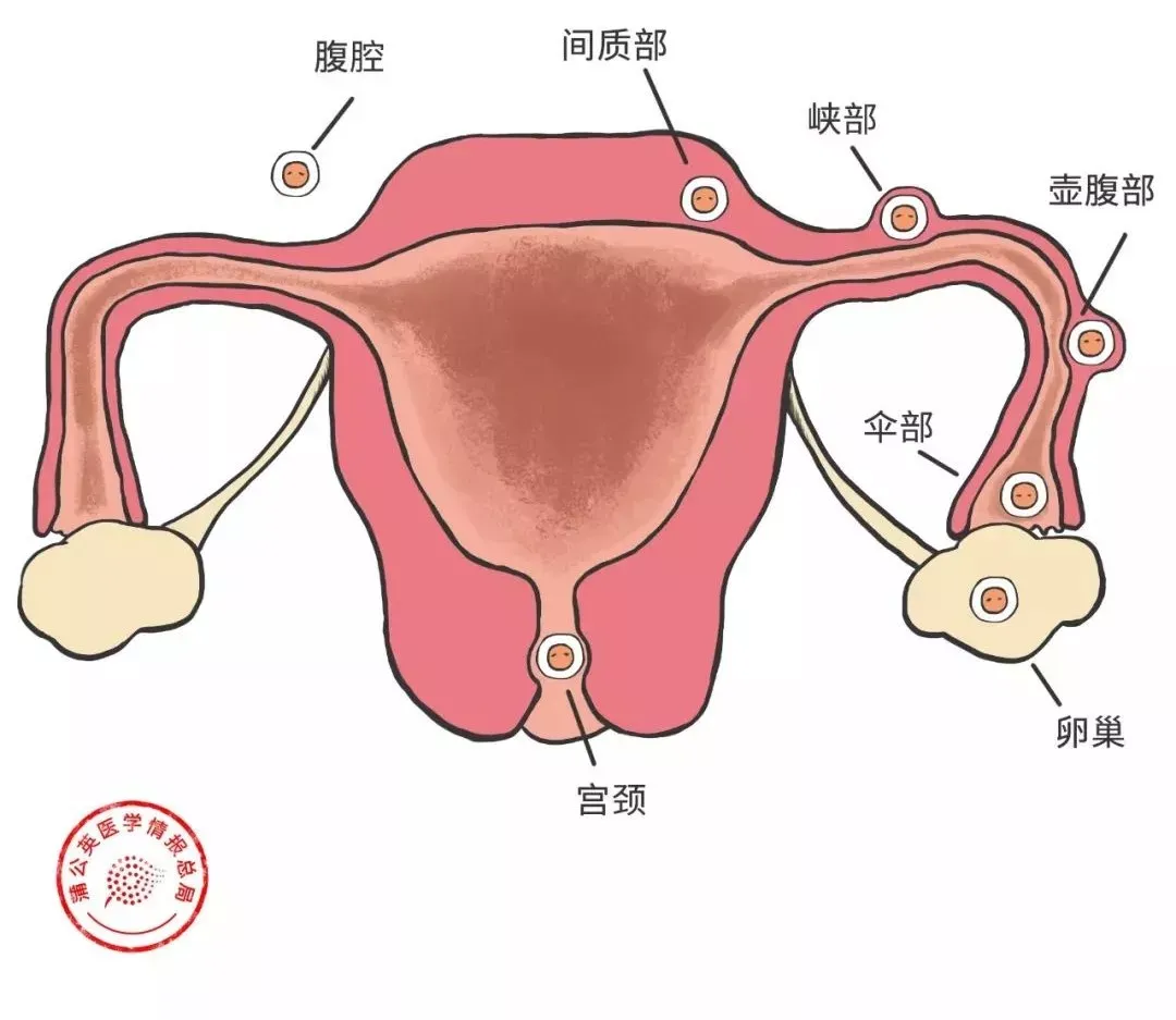 宫外孕是怎么回事？不能预防吗？切除输卵管，以后还能怀孕吗？