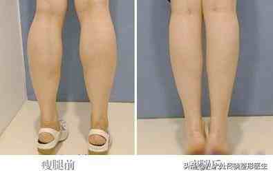 说到瘦腿针小仙女们并不陌生，但是打瘦腿针有没有副作用呢？