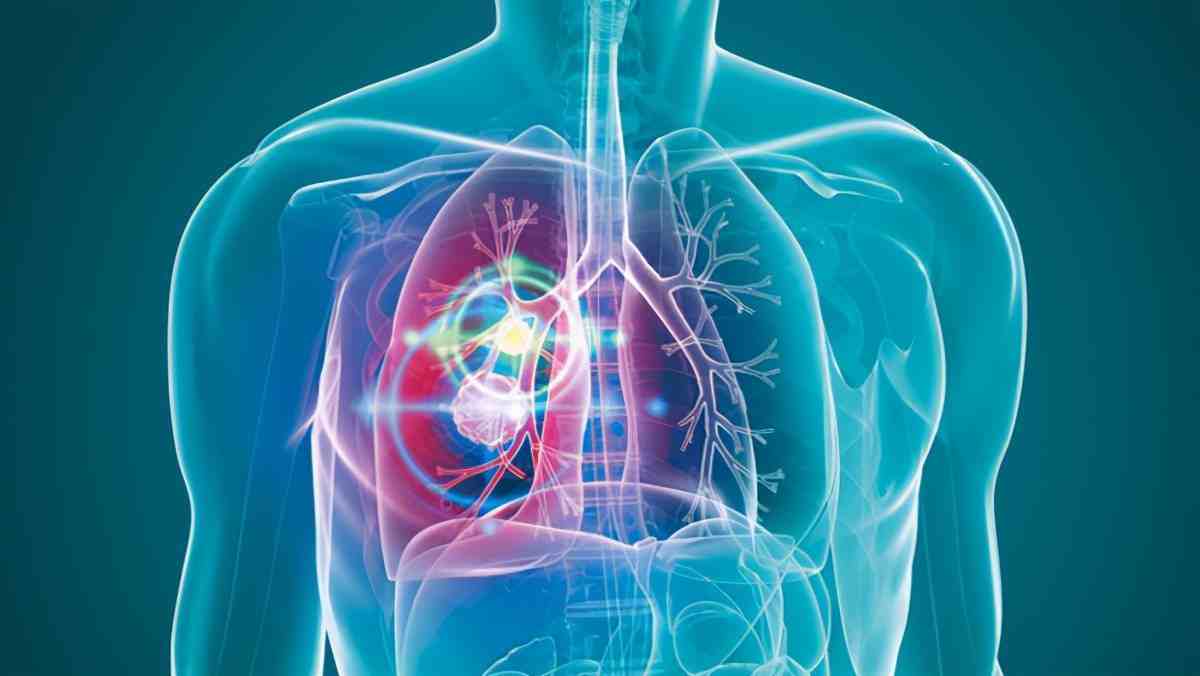 肺癌放疗期间常见的不良反应，以及应对方法
