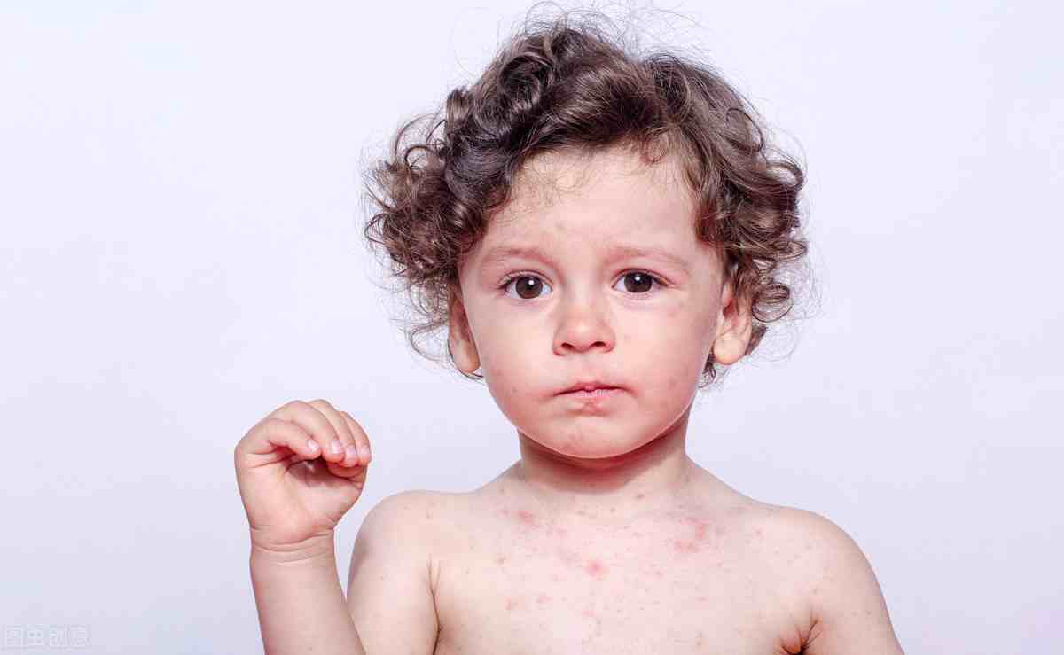 荨麻疹的简单又根治的方法，预防其五大并发病
