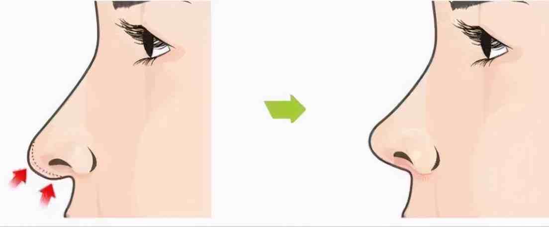 鼻部手术为何需重视鼻尖塑型