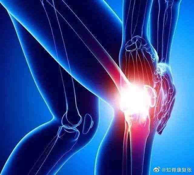 有一种膝盖疼叫“髌骨软化综合症”