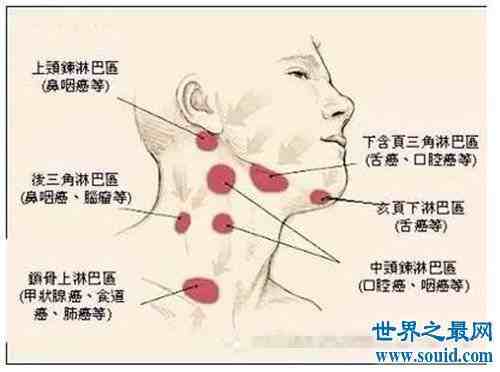 單發性)鎖骨上窩:轉移性腫瘤,淋巴結結核(多發性)頸側區:胸腺咽管囊腫