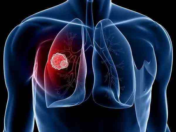 肺癌的常见症状有哪些？肺癌高危人群出现这些症状要警惕