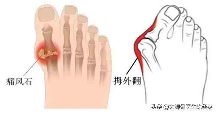 大脚趾痛要区分原因：是痛风还是拇外翻