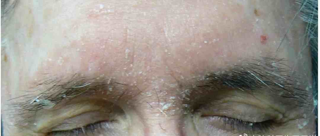脂溢性皮炎治疗全攻略，眉间鼻翼不再泛红发痒