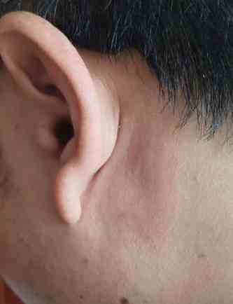 中耳炎治疗——三剂中药两剂痊愈