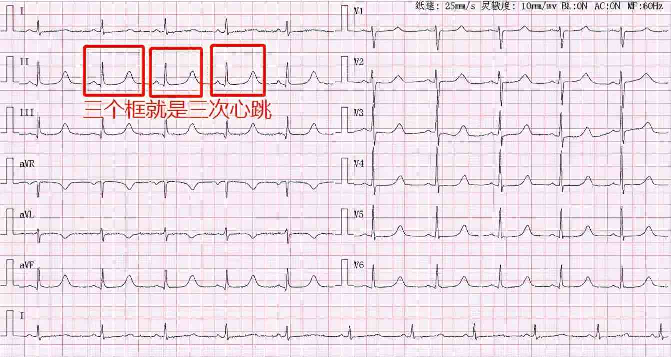 這是做心電圖檢查時在身體不同位置接收到心臟的波形.