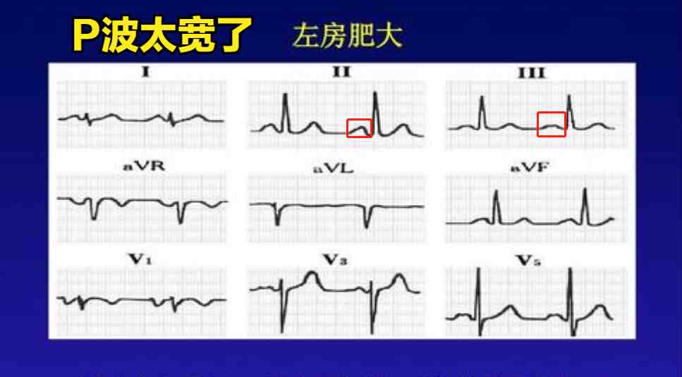 普通人怎么看心电图？医生说：把图上的线条和心脏的跳动结合起来