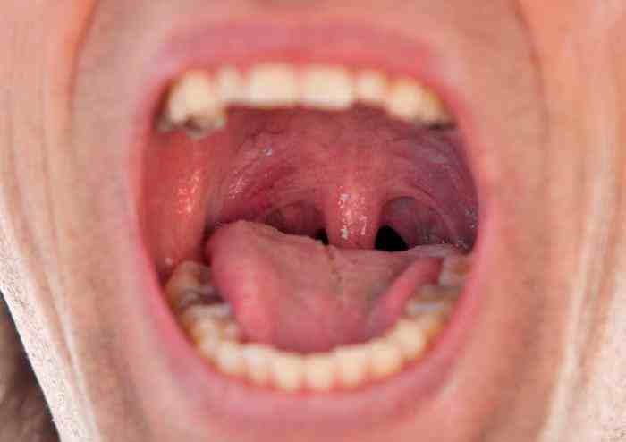 口腔软腭发炎怎么办图片
