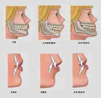 口腔正畸的矫治标准全攻略-口腔正畸治疗