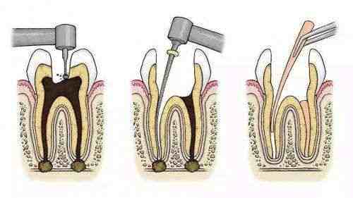 什么是根管治疗？用针探入牙齿不会疼吗？做根管之前你要知道这些