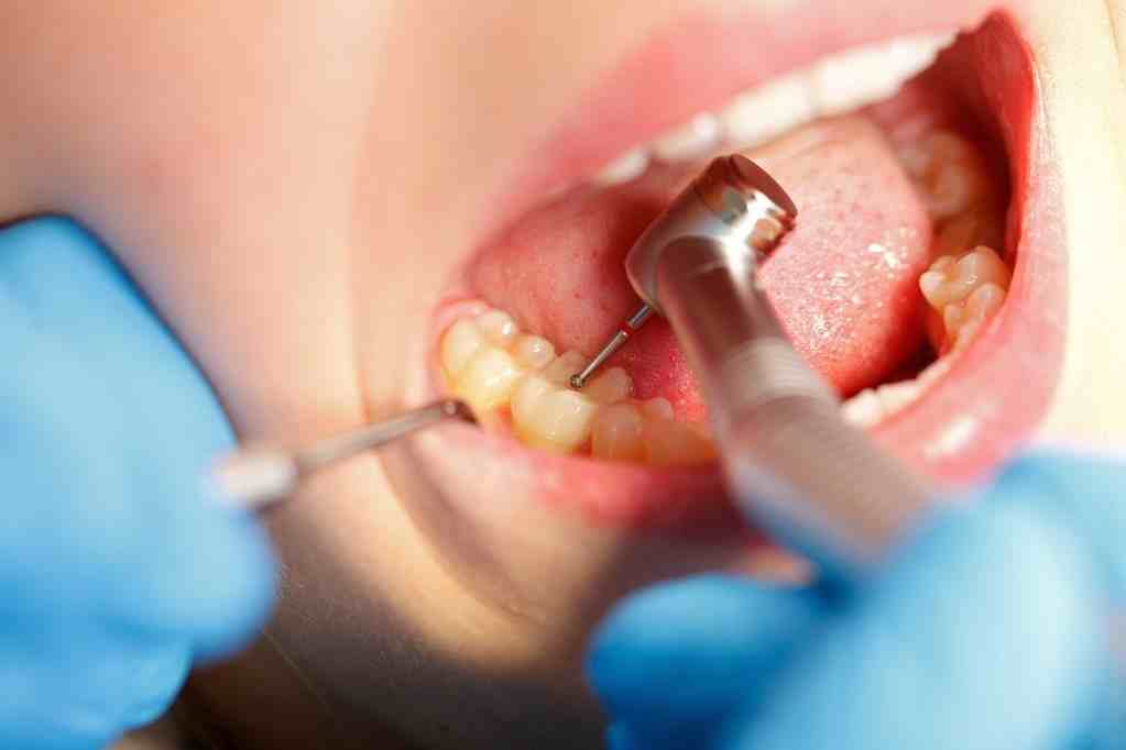 什么是根管治疗？用针探入牙齿不会疼吗？做根管之前你要知道这些