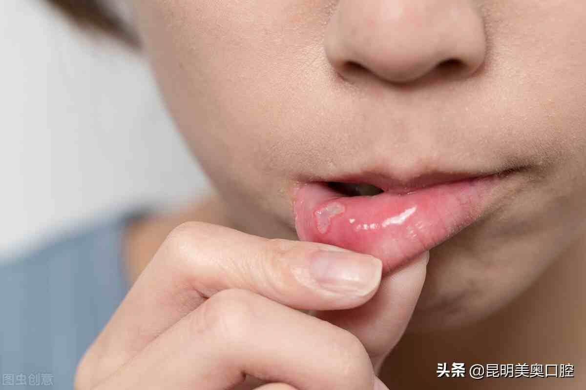 口疮的快速治疗方法|怎么快速治好口腔溃疡？