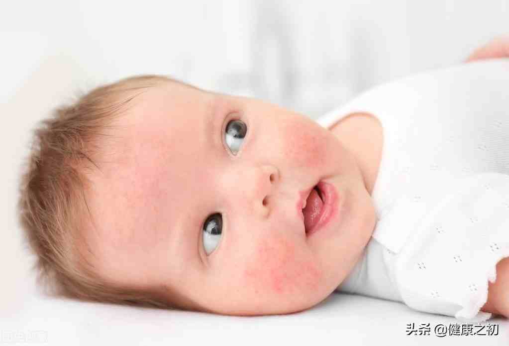 婴儿湿疹图片|宝宝湿疹越来越重？