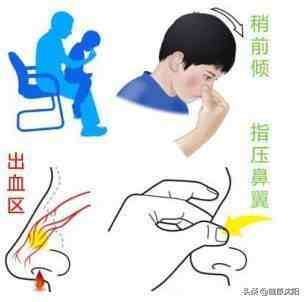 健康科普堂 | 儿童鼻出血的处理和预防