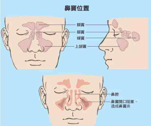 过敏性鼻炎的症状有哪些常见表现