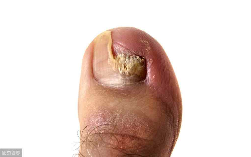 5种治疗灰指甲常用药物详解