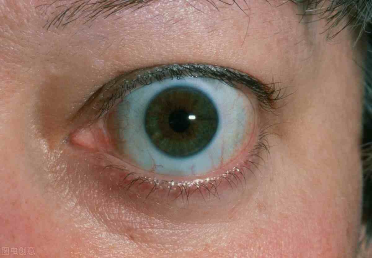 眼球突出是因为甲亢吗？甲亢有什么症状及表现