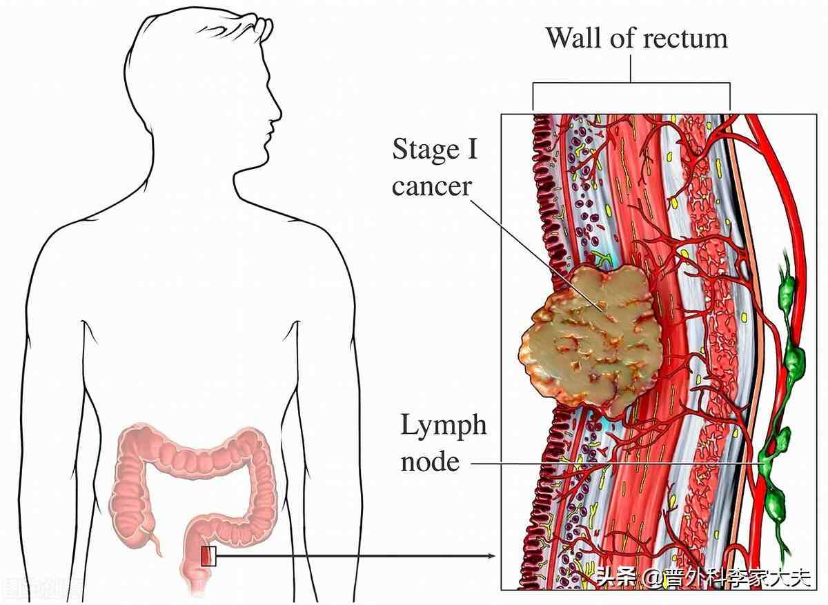 直肠癌有什么症状？