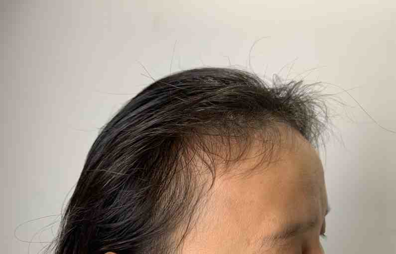女生发际线后移是什么原因？雄激素性脱发还是前额秃发？教你区分