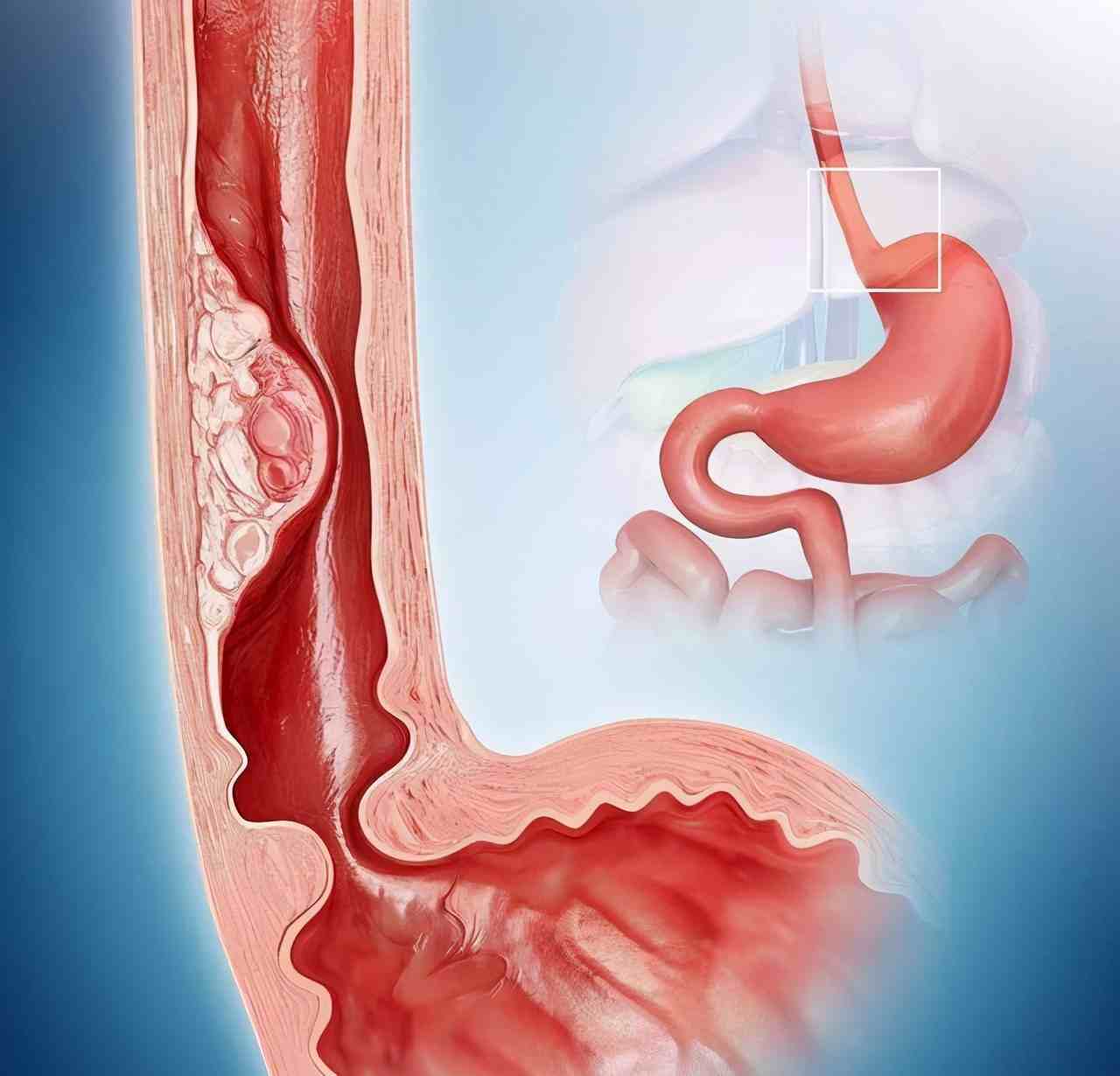 食道癌的早期症状表现图片