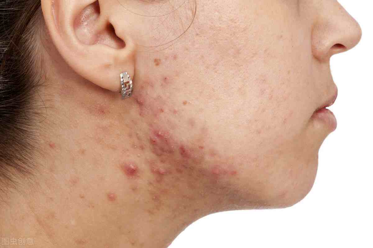 痤疮是一种毛囊皮脂腺的慢性炎症性皮肤病,多发于青春期