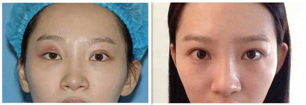 双眼皮手术修复有哪些方法