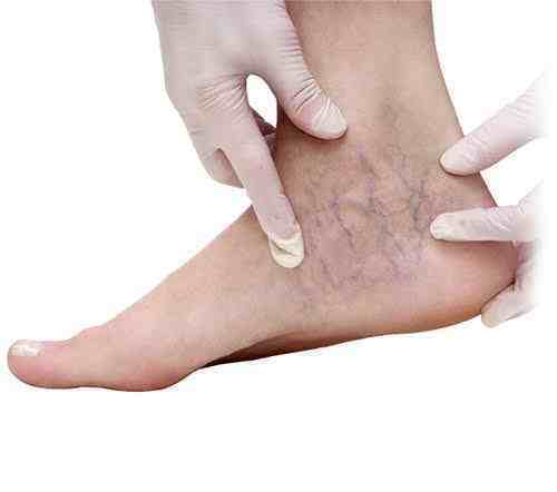 脚踝肿胀的原因有哪些？