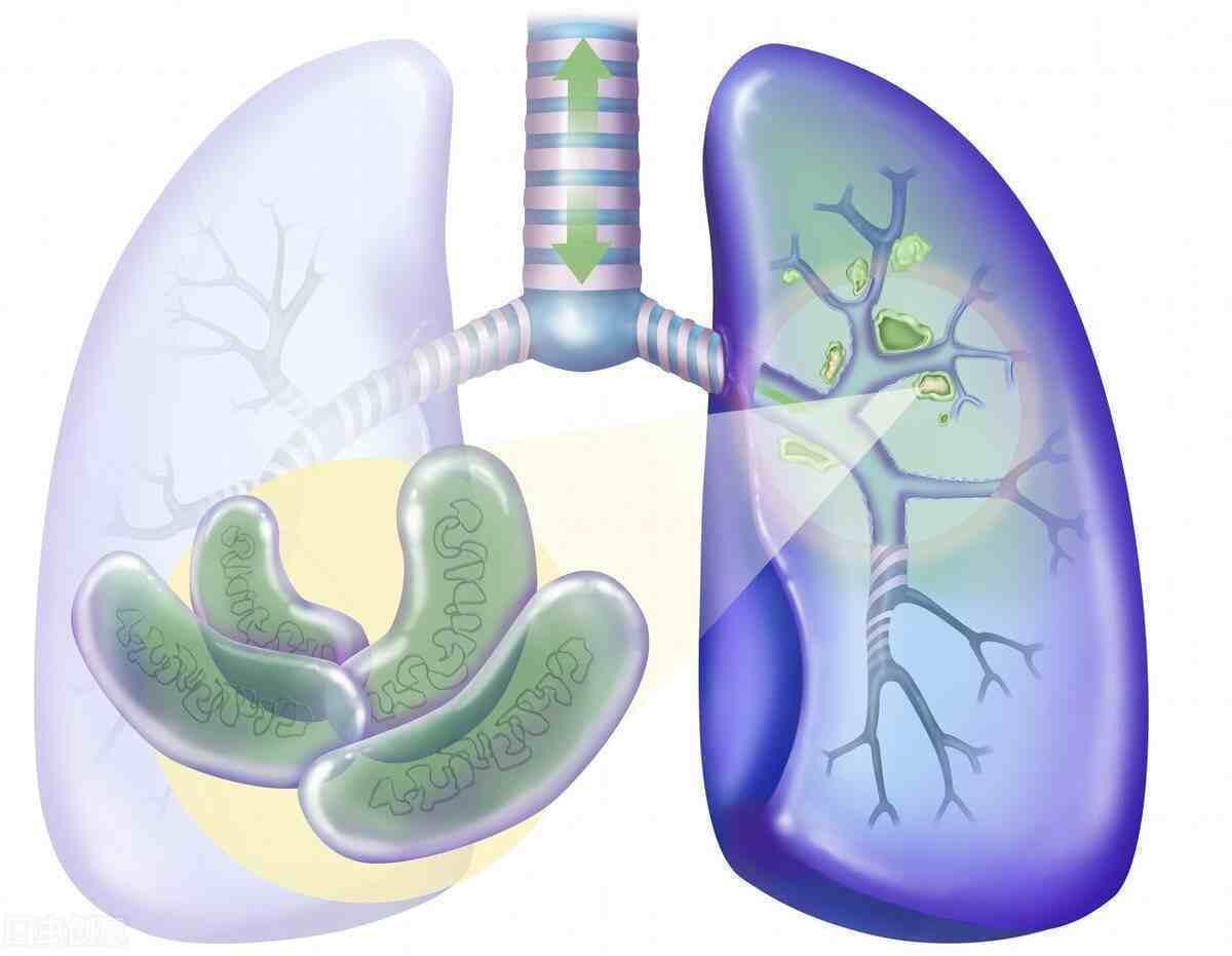 你身邊有人得肺結核嗎?到底肺結核是一種什麼疾病?