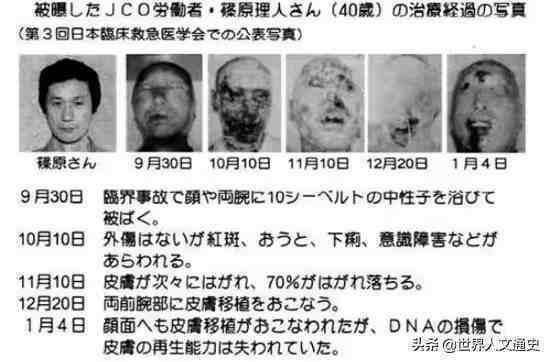 核辐射有多可怕？日本工人全身DNA断裂，高度腐烂，挣扎83天断气