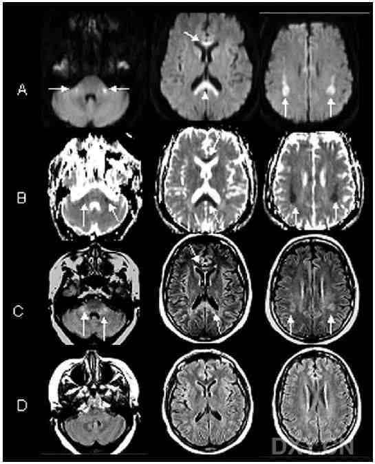 圖:dwi 見雙側對稱性大腦深部白質及胼胝體膝部和壓部的高信號;c～d
