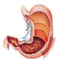 胃间质瘤（关于胃肠间质瘤）
