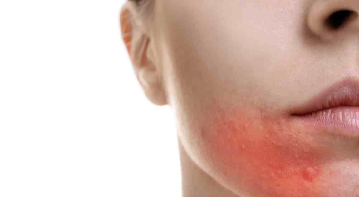 什么是季节性皮肤过敏？应注意什么？