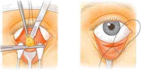 去眼袋必知：去眼袋的四种经典手术方法