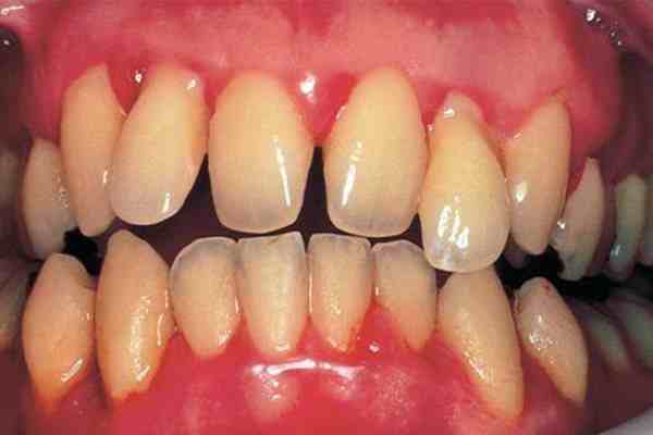 牙龈发炎怎么办（牙龈肿胀怎么办？）