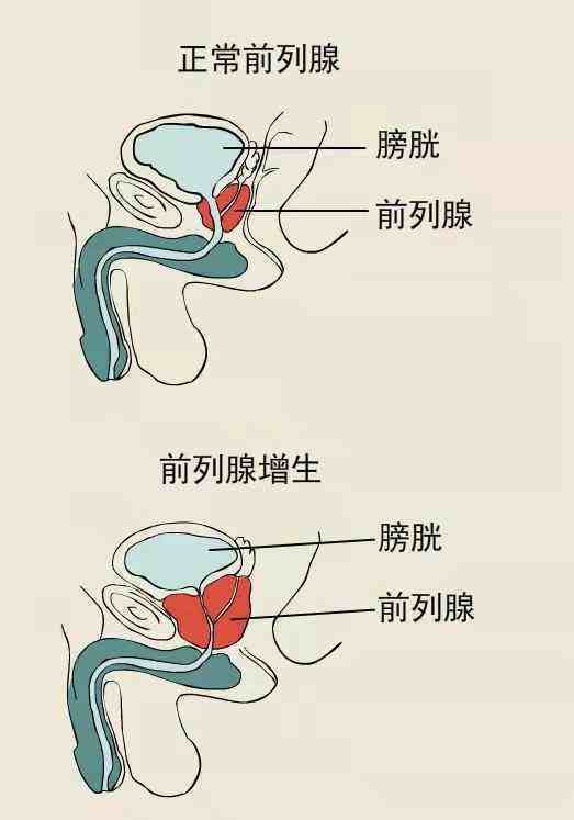 前列腺增生的治疗方法（前列腺增生的治疗方法以及秋季预防措施）