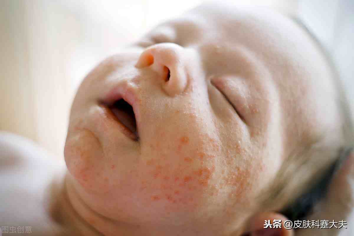 婴儿湿疹的原因？（宝宝为什么会得婴儿湿疹？）
