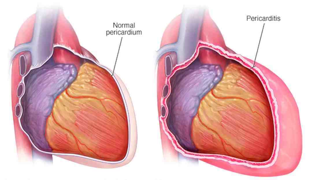 胸痛的原因（引起胸痛常见的12种病因）