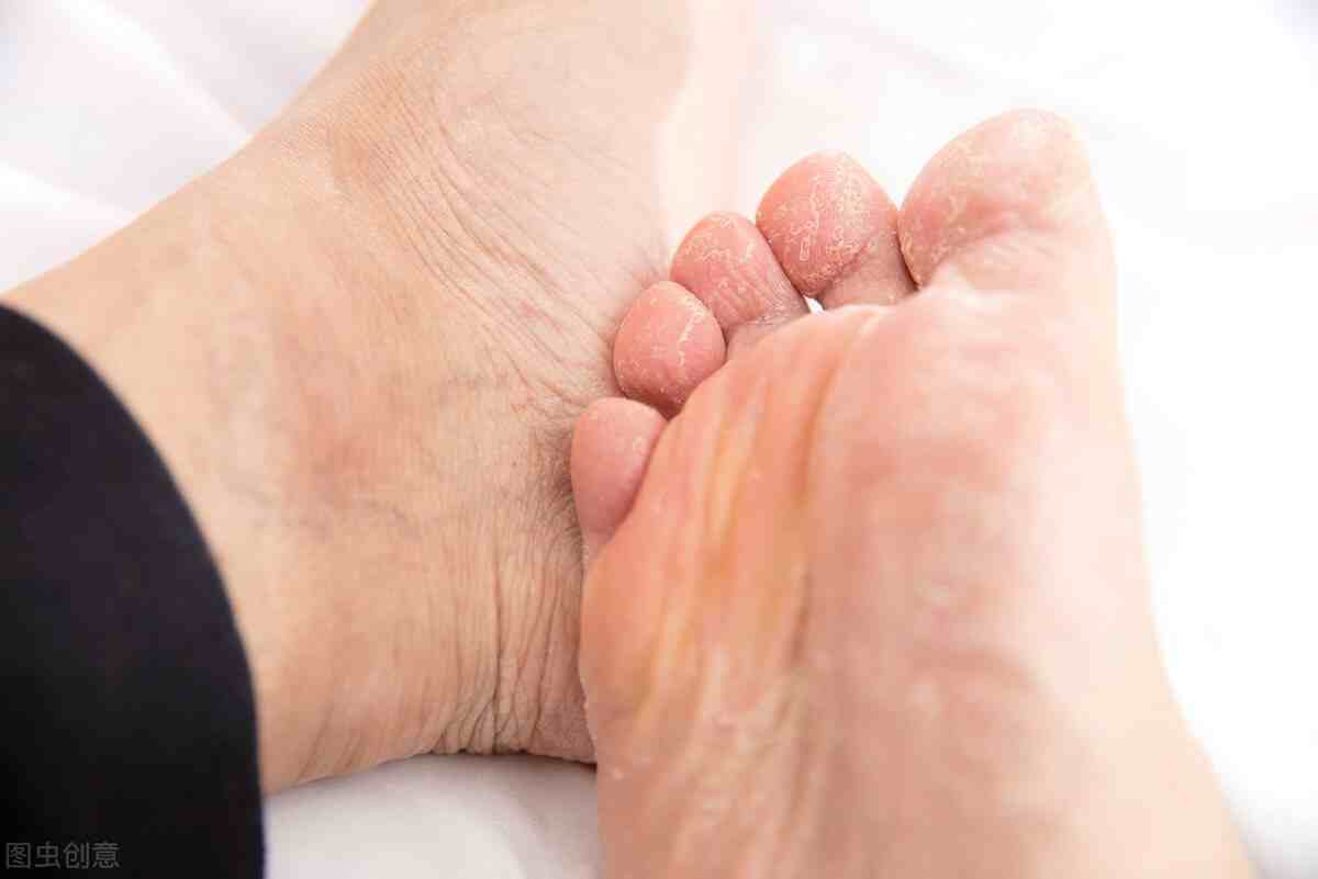 什么是脚气病（引起脚气的病因有哪些？）