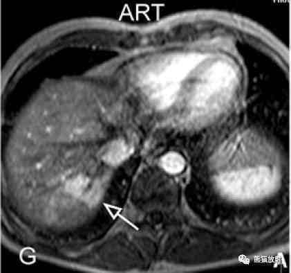 肝脏多发血管瘤（肝脏血管瘤的六类表现）