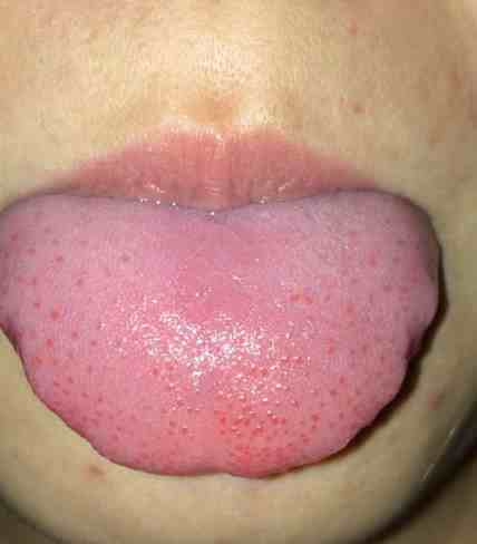 舌头上有红点是怎么回事？