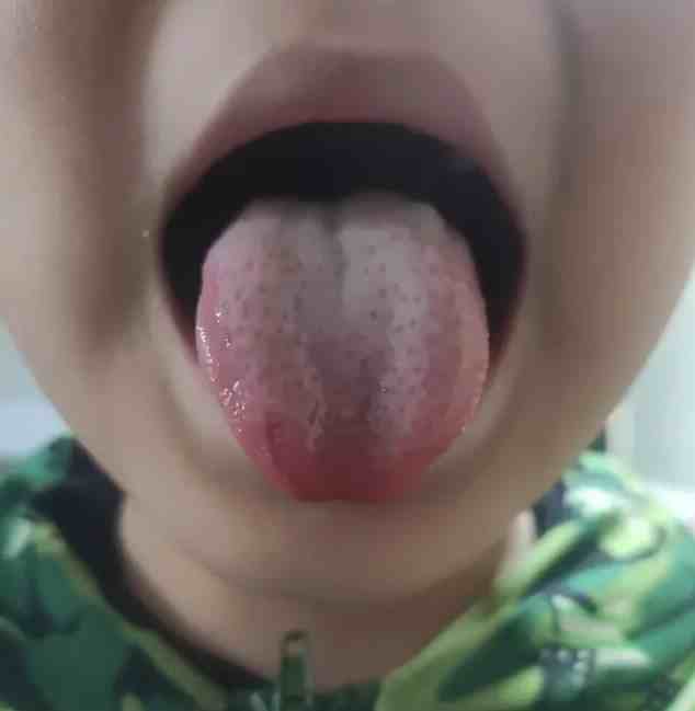 舌头上有小红点（舌头上全是红点点怎么回事）