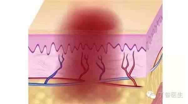 毛细血管扩张,如果此时突然吹来一阵风,会让扩张的毛细血管收缩,导致